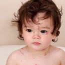 Комаровский назвал возможные причины возникновения сыпи у детей