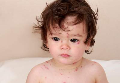 Комаровский назвал возможные причины возникновения сыпи у детей